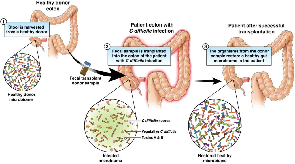 Fecal Microbiota Transplantation (FMT) involves transferring stool from a healthy donor into a patie