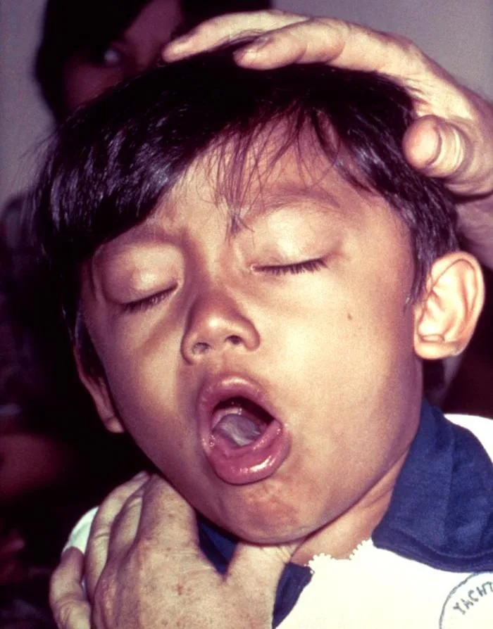 Pertussis, commonly known as whooping cough, is a highly contagious respiratory infection that can b