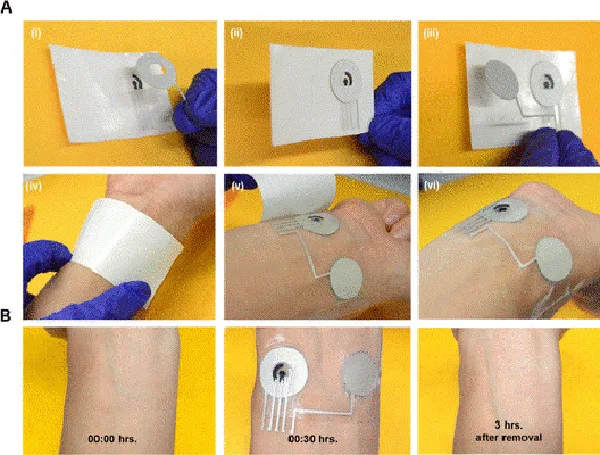 A continuous glucose monitoring (CGM) device, like this one, exemplifies the new generation of mobil